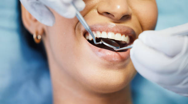 Best Emergency Tooth Extraction in Crawfordsville, IN