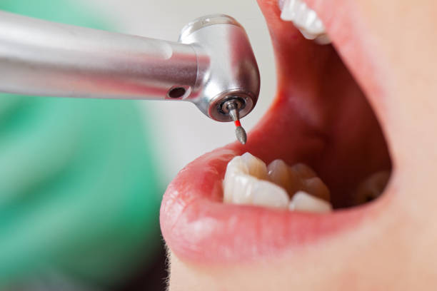 Best Emergency Treatment for Dental Infections or Abscesses in Crawfordsville, IN